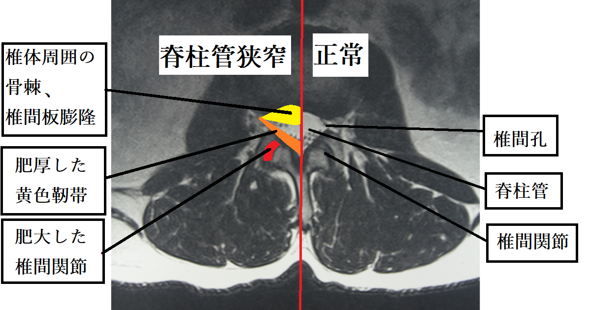 正常な脊柱管と脊柱管狭窄症のMRI